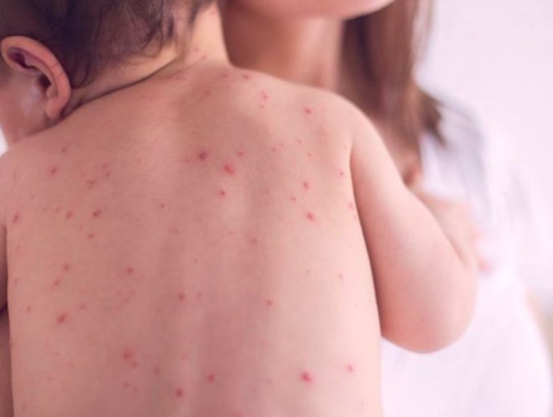 ХӨСҮТ: Улаанбурхан өвчний батлагдсан тохиолдол 7 болж нэмэгдлээ